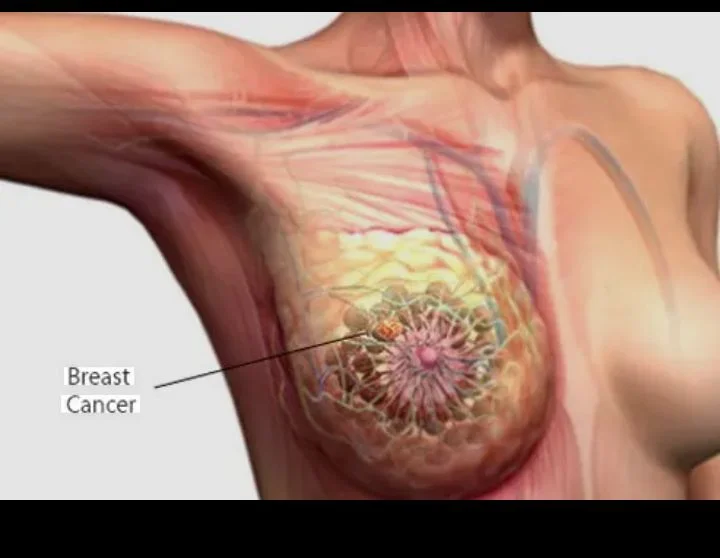 Breast cancer remains leading cause of death for African women