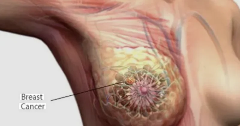 Breast cancer causes 100,070 deaths in Africa annually